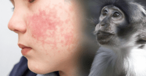 Monkeypox Virus