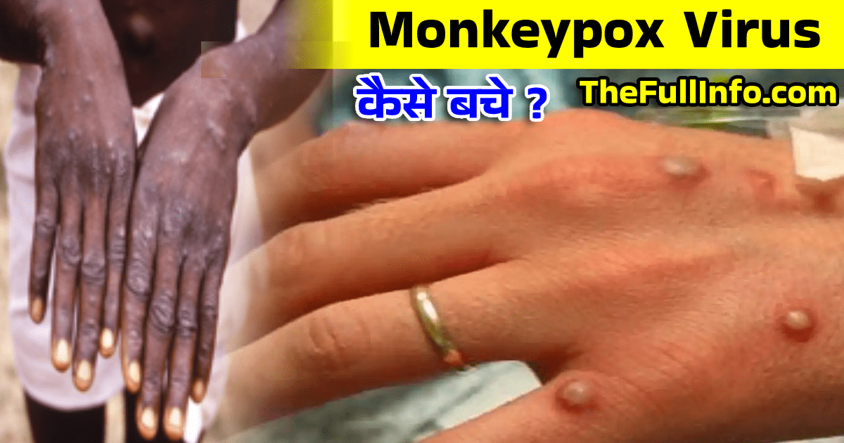 Monkeypox Virus